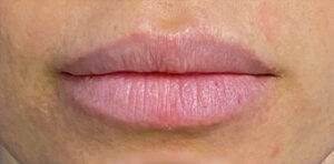 Lip Augmentation