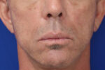 FACEology Lift / Neck Lift