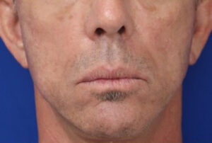 FACEology Lift / Neck Lift