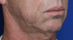 FACEology Lift / Neck Lift