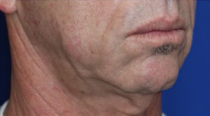 FACEology Lift / Neck Lift