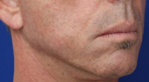 FACEology Lift / Neck Lift