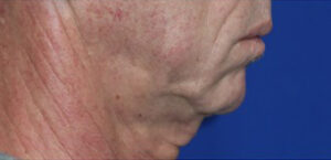 FACEology Lift / Neck Lift