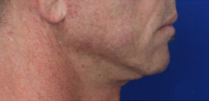 FACEology Lift / Neck Lift