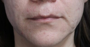 FACEology Lift / Neck Lift Case 14722 Before Photo FACEology Lift / Neck Lift