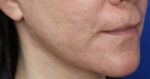 FACEology Lift / Neck Lift