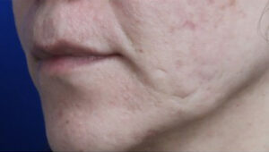 FACEology Lift / Neck Lift Case 14722 Before Photo FACEology Lift / Neck Lift
