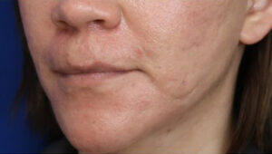 FACEology Lift / Neck Lift Case 14722 After Photo FACEology Lift / Neck Lift