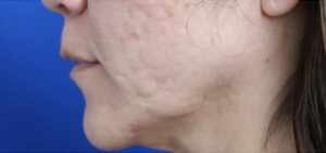 FACEology Lift / Neck Lift Case 14722 Before Photo FACEology Lift / Neck Lift