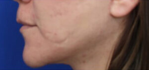 FACEology Lift / Neck Lift Case 14722 After Photo FACEology Lift / Neck Lift