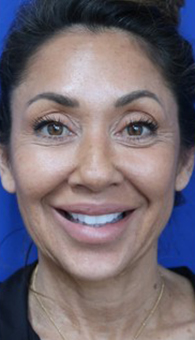 FACEology Lift / Neck Lift Case 14723 Before Photo FACEology Lift / Neck Lift