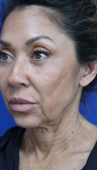 FACEology Lift / Neck Lift Case 14723 Before Photo FACEology Lift / Neck Lift