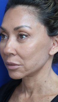 FACEology Lift / Neck Lift Case 14723 After Photo FACEology Lift / Neck Lift