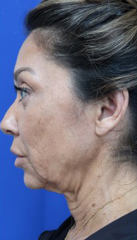 FACEology Lift / Neck Lift Case 14723 Before Photo FACEology Lift / Neck Lift