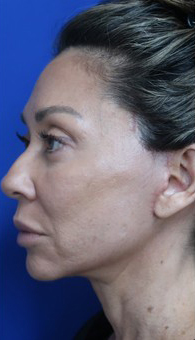 FACEology Lift / Neck Lift Case 14723 After Photo FACEology Lift / Neck Lift
