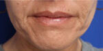FACEology Lift / Neck Lift
