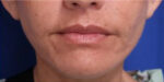 FACEology Lift / Neck Lift
