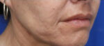 FACEology Lift / Neck Lift