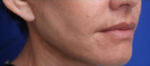 FACEology Lift / Neck Lift