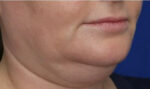 FACEology Lift / Neck Lift