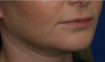 FACEology Lift / Neck Lift