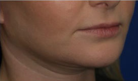FACEology Lift / Neck Lift Case 15797 After Photo FACEology Lift / Neck Lift