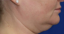 FACEology Lift / Neck Lift Case 15797 Before Photo FACEology Lift / Neck Lift
