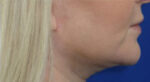 FACEology Lift / Neck Lift