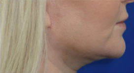 FACEology Lift / Neck Lift Case 15797 After Photo FACEology Lift / Neck Lift