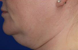 FACEology Lift / Neck Lift Case 15797 Before Photo FACEology Lift / Neck Lift