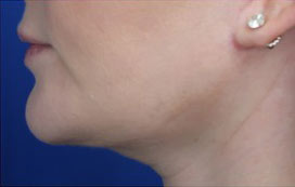 FACEology Lift / Neck Lift Case 15797 After Photo FACEology Lift / Neck Lift