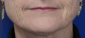 FACEology Lift / Neck Lift Case 15798 Before Photo FACEology Lift / Neck Lift