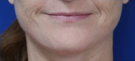 FACEology Lift / Neck Lift Case 15798 After Photo FACEology Lift / Neck Lift