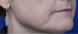 FACEology Lift / Neck Lift Case 15798 Before Photo FACEology Lift / Neck Lift