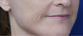 FACEology Lift / Neck Lift Case 15798 After Photo FACEology Lift / Neck Lift