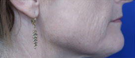 FACEology Lift / Neck Lift Case 15798 Before Photo FACEology Lift / Neck Lift