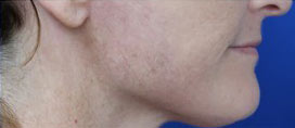 FACEology Lift / Neck Lift Case 15798 After Photo FACEology Lift / Neck Lift