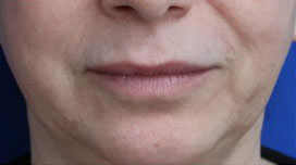 Lip Augmentation Case 15799 Before Photo Lip Augmentation