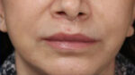 Lip Augmentation