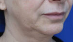 Lip Augmentation