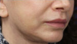 Lip Augmentation