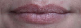 Lip Augmentation Case 15800 Before Photo Lip Augmentation