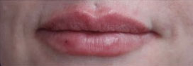 Lip Augmentation Case 15800 After Photo Lip Augmentation