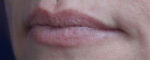 Lip Augmentation