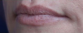 Lip Augmentation Case 15800 Before Photo Lip Augmentation