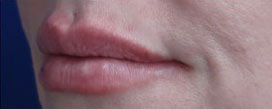 Lip Augmentation Case 15800 After Photo Lip Augmentation