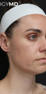 Ear Surgery