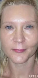 CO2 Laser Case 16481 After Photo CO2 Laser