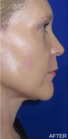 CO2 Laser Case 16481 After Photo CO2 Laser