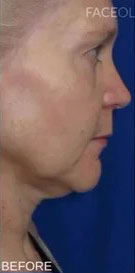 CO2 Laser Case 16481 Before Photo CO2 Laser